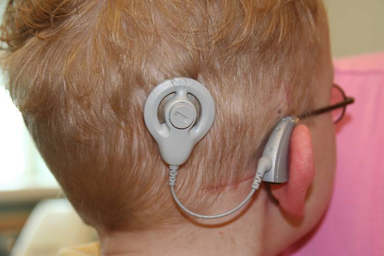 Foto de un implante coclear en la cabeza de un niño rubio